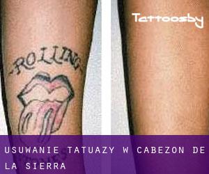 Usuwanie tatuaży w Cabezón de la Sierra