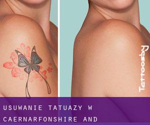 Usuwanie tatuaży w Caernarfonshire and Merionethshire