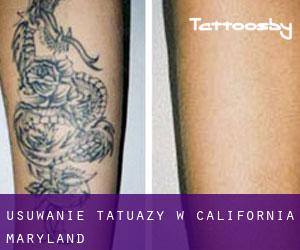 Usuwanie tatuaży w California (Maryland)
