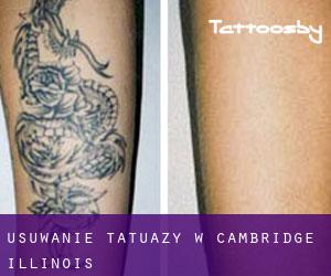 Usuwanie tatuaży w Cambridge (Illinois)