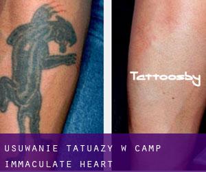 Usuwanie tatuaży w Camp Immaculate Heart