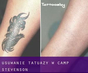 Usuwanie tatuaży w Camp Stevenson