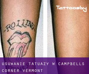 Usuwanie tatuaży w Campbells Corner (Vermont)