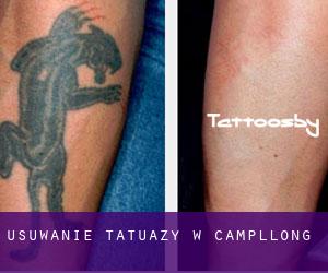 Usuwanie tatuaży w Campllong