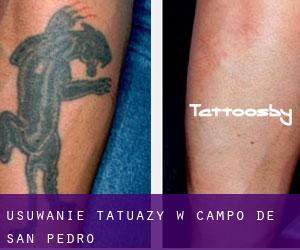 Usuwanie tatuaży w Campo de San Pedro