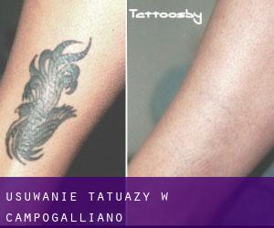 Usuwanie tatuaży w Campogalliano