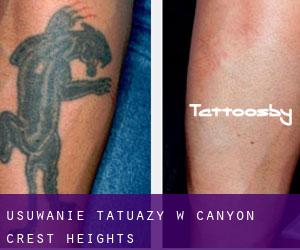 Usuwanie tatuaży w Canyon Crest Heights