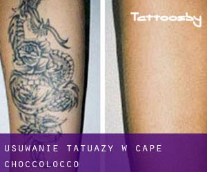 Usuwanie tatuaży w Cape Choccolocco