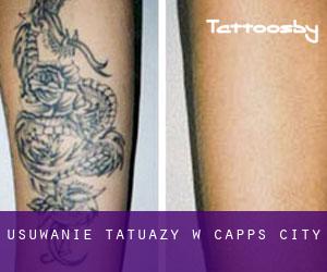 Usuwanie tatuaży w Capps City