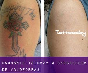 Usuwanie tatuaży w Carballeda de Valdeorras