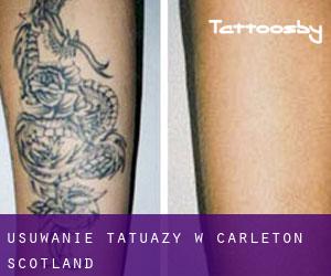 Usuwanie tatuaży w Carleton (Scotland)
