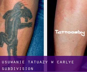 Usuwanie tatuaży w Carlye Subdivision