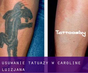 Usuwanie tatuaży w Caroline (Luizjana)