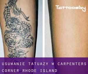 Usuwanie tatuaży w Carpenters Corner (Rhode Island)