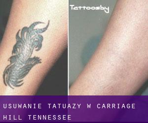 Usuwanie tatuaży w Carriage Hill (Tennessee)