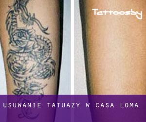 Usuwanie tatuaży w Casa Loma