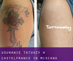 Usuwanie tatuaży w Castelfranco in Miscano