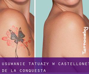 Usuwanie tatuaży w Castellonet de la Conquesta