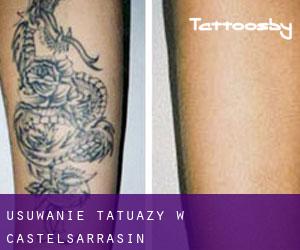 Usuwanie tatuaży w Castelsarrasin