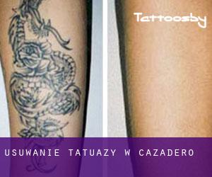 Usuwanie tatuaży w Cazadero