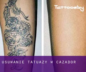 Usuwanie tatuaży w Cazador