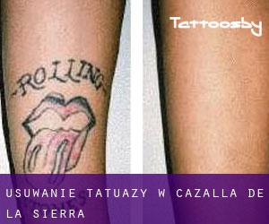 Usuwanie tatuaży w Cazalla de la Sierra