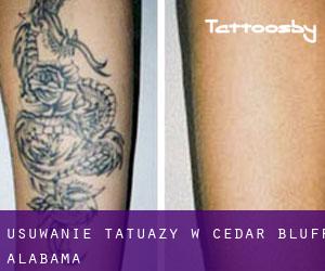 Usuwanie tatuaży w Cedar Bluff (Alabama)