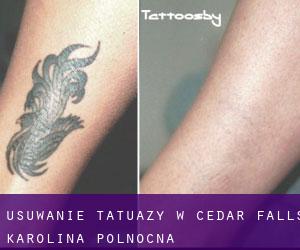 Usuwanie tatuaży w Cedar Falls (Karolina Północna)