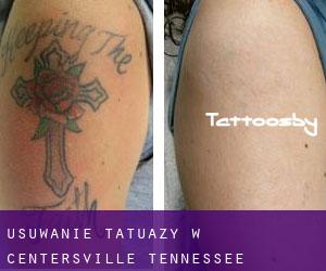 Usuwanie tatuaży w Centersville (Tennessee)