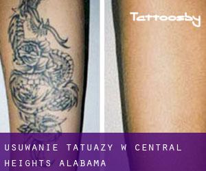 Usuwanie tatuaży w Central Heights (Alabama)