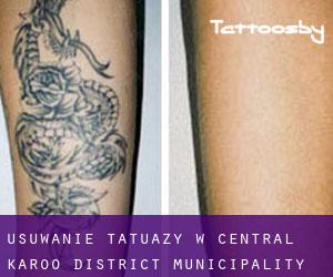 Usuwanie tatuaży w Central Karoo District Municipality