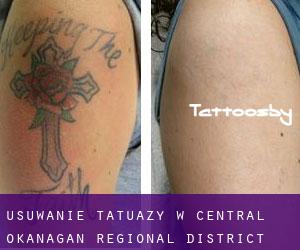 Usuwanie tatuaży w Central Okanagan Regional District
