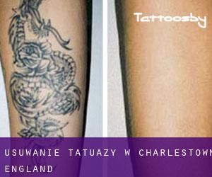 Usuwanie tatuaży w Charlestown (England)