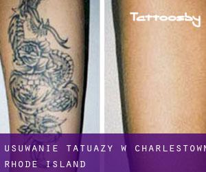 Usuwanie tatuaży w Charlestown (Rhode Island)