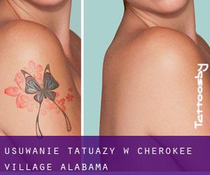 Usuwanie tatuaży w Cherokee Village (Alabama)