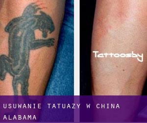 Usuwanie tatuaży w China (Alabama)