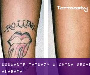 Usuwanie tatuaży w China Grove (Alabama)