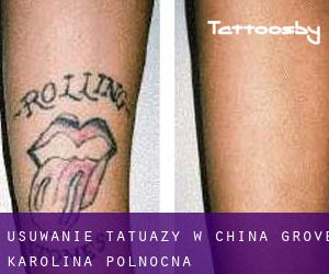 Usuwanie tatuaży w China Grove (Karolina Północna)