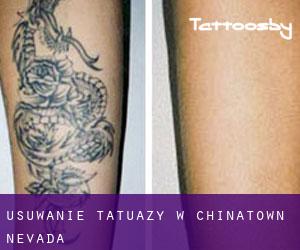 Usuwanie tatuaży w Chinatown (Nevada)