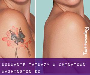 Usuwanie tatuaży w Chinatown (Washington, D.C.)