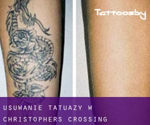 Usuwanie tatuaży w Christophers Crossing