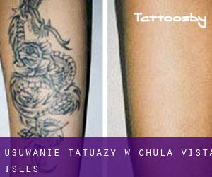 Usuwanie tatuaży w Chula Vista Isles