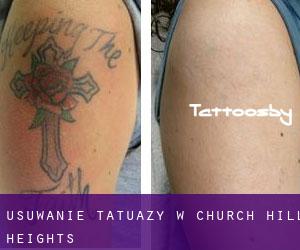 Usuwanie tatuaży w Church Hill Heights