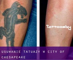 Usuwanie tatuaży w City of Chesapeake