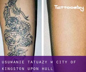 Usuwanie tatuaży w City of Kingston upon Hull