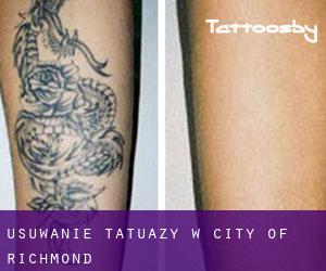 Usuwanie tatuaży w City of Richmond