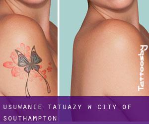 Usuwanie tatuaży w City of Southampton