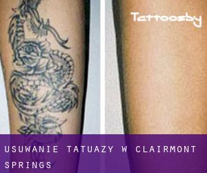 Usuwanie tatuaży w Clairmont Springs