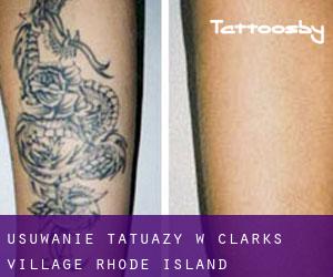 Usuwanie tatuaży w Clarks Village (Rhode Island)