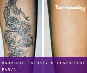 Usuwanie tatuaży w Claybrooke Parva